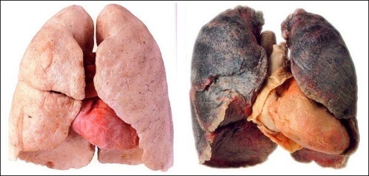 Hình ảnh lá phổi ở người bình thường và người hút thuốc lá