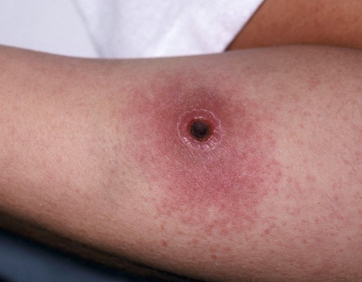 Bệnh than là bệnh nhiễm khuẩn cấp tính thường làm tổn thương da