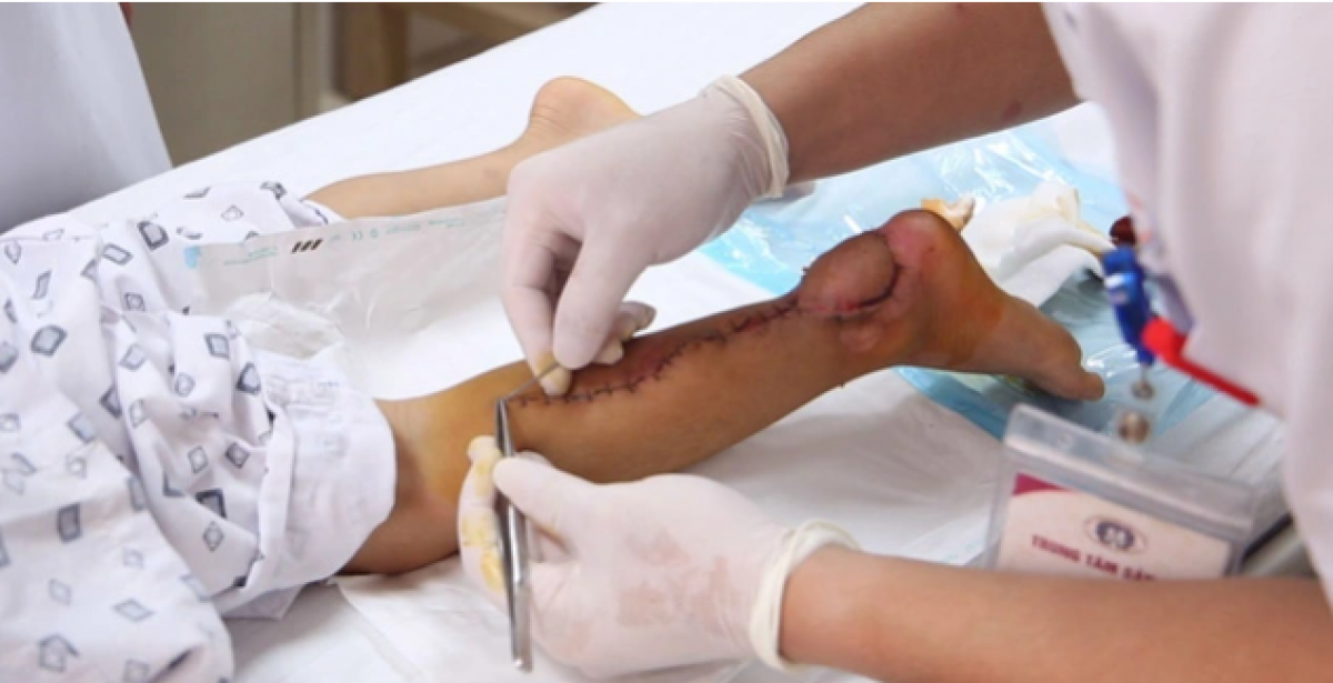 Nhiều trường hợp bác sỹ phải tiến hành ghép da do trẻ bị khuyết da nhiều sau khi kẹp chân vào nan hoa xe đạp
