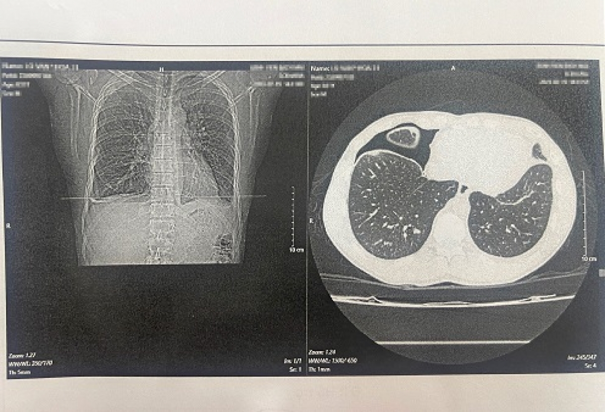Hình ảnh phim chụp trên bệnh nhân sán lá phổi