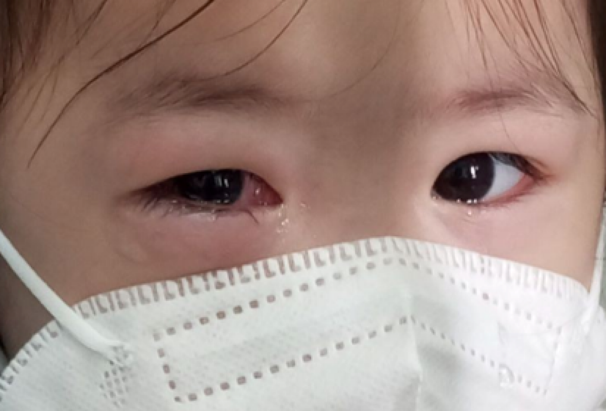 Cha mẹ nên đưa trẻ đi khám đau mắt đỏ ngay ngày đầu tiên bị bệnh