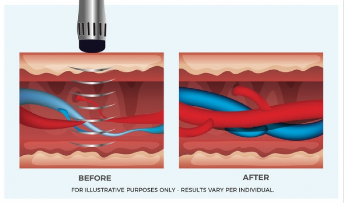 Hình ảnh mô phỏng mạch máu trước và sau khi điều trị bằng sóng xung kích