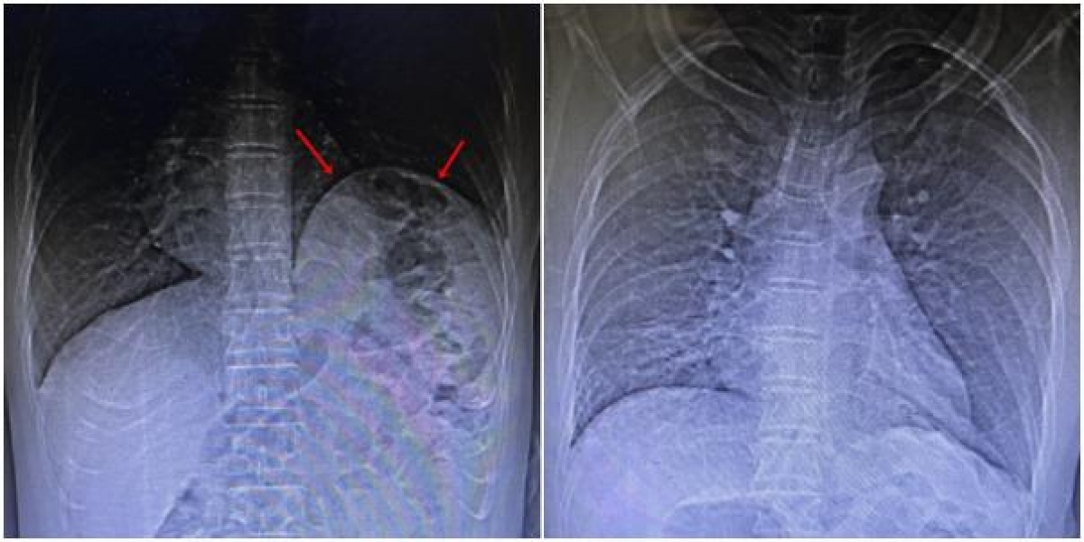 Hình ảnh X-quang và cắt lớp phổi của bệnh nhân bị nhão cơ hoành trái khiến tạng dưới ổ bụng di chuyển lên trên, trước và sau phẫu thuật
