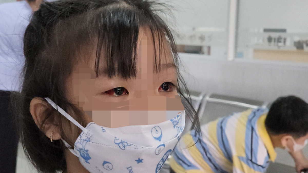 Trẻ nhỏ dễ bị lây lan thành dịch đau mắt đỏ do thói quen sinh hoạt hằng ngày