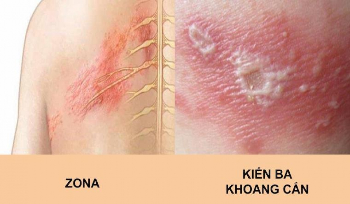 Phân biệt tổn thương do zona và viêm da tiếp xúc do kiến ba khoang
