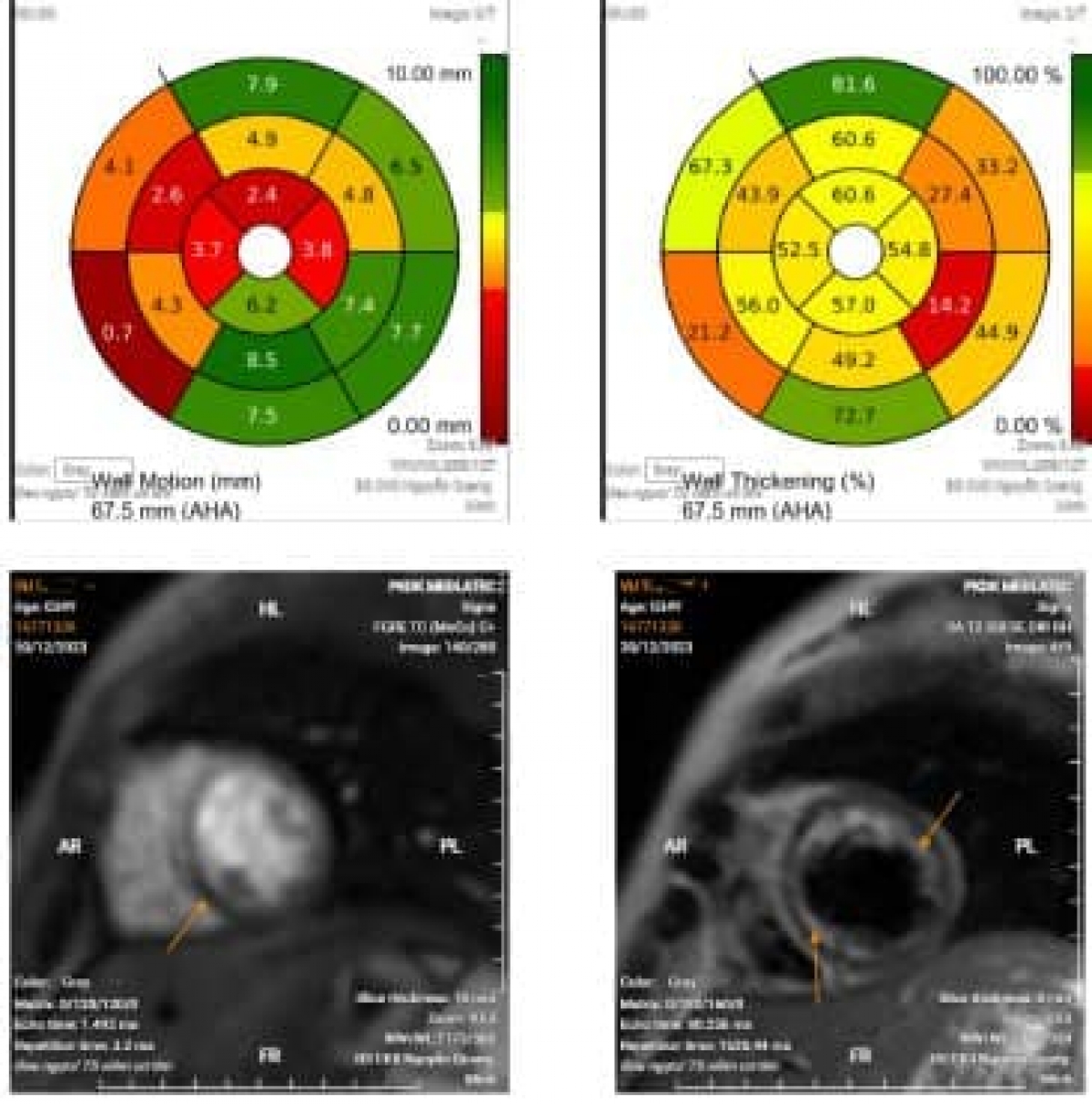 Hình ảnh chụp MRI tim của bệnh nhân L.cho thấy tổn thương tim không phục hồi. Vùng màu đỏ thể hiện giảm chức năng co bóp bơm máu của tim còn 52%.