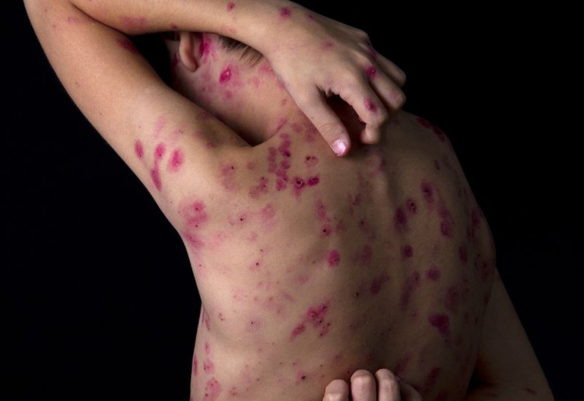 Người bệnh mắc thủy đậu nên tránh chà xát, gãi vùng da tổn thương 