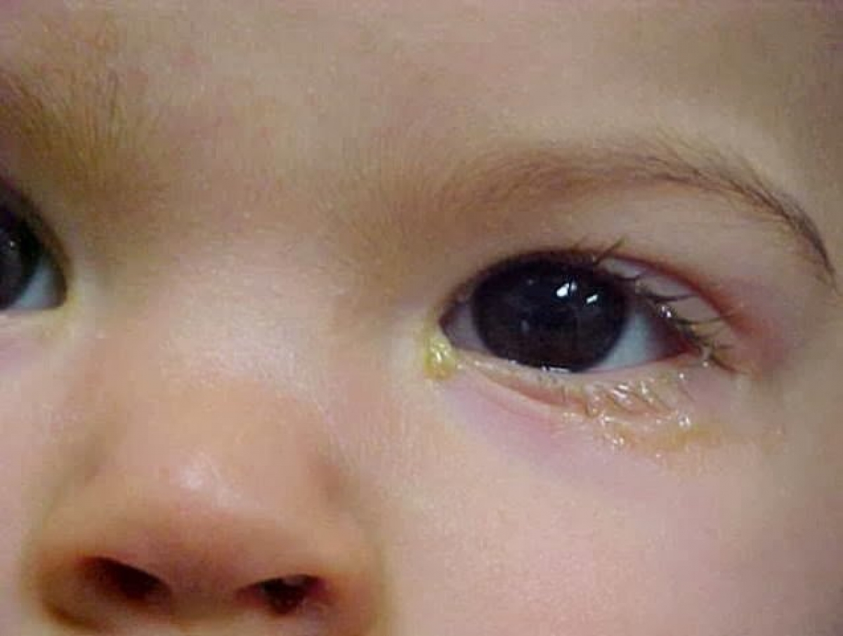 Trẻ bị tắc tuyến lệ đạo thường bờ mi sẽ bị viêm, nhiều gỉ mắt