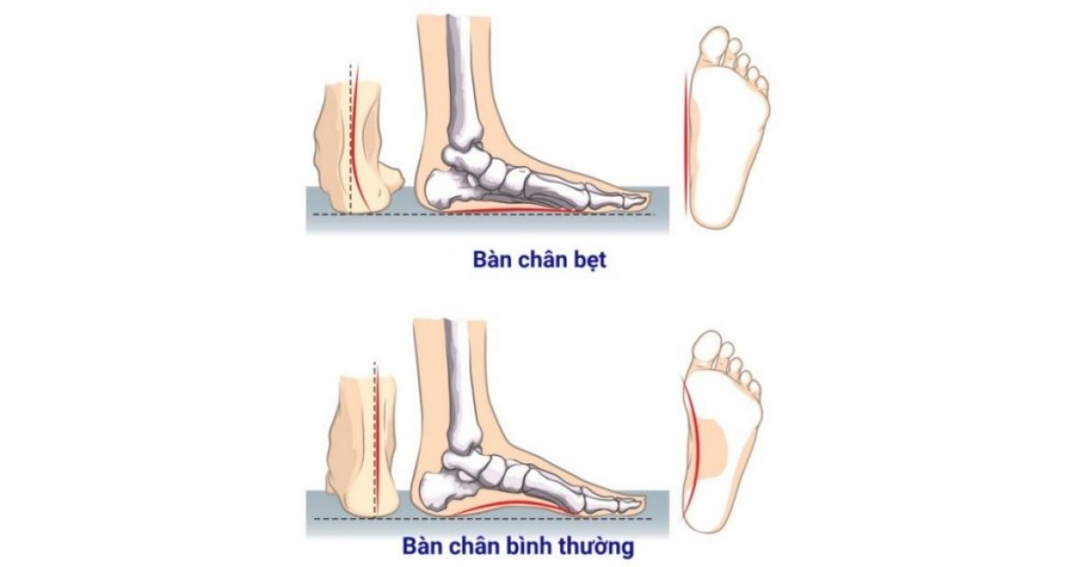 Hình ảnh bàn chân bẹt và bàn chân bình thường