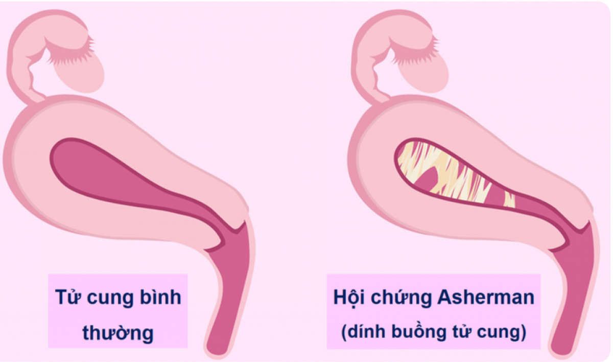 Hình ảnh tử cung bình thường và tử cung bị dính