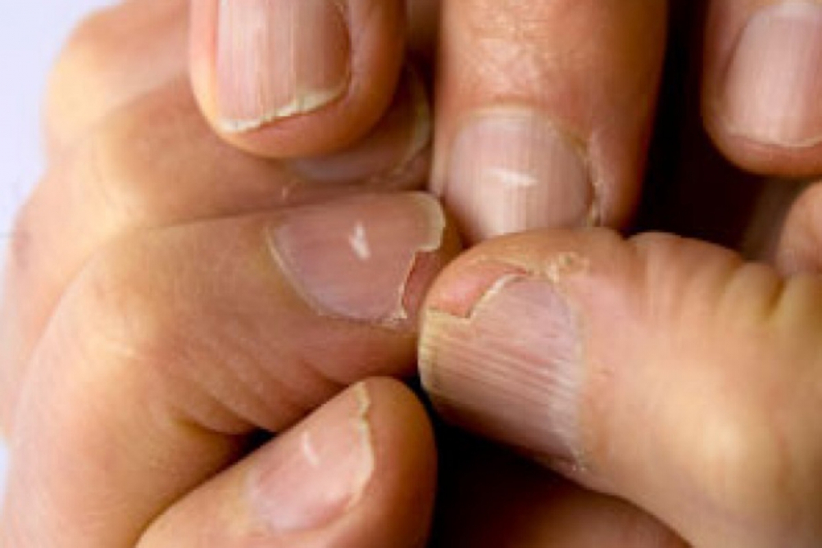 Sự thiếu hụt kẽm có thể gây ra móng khô và dễ gãy