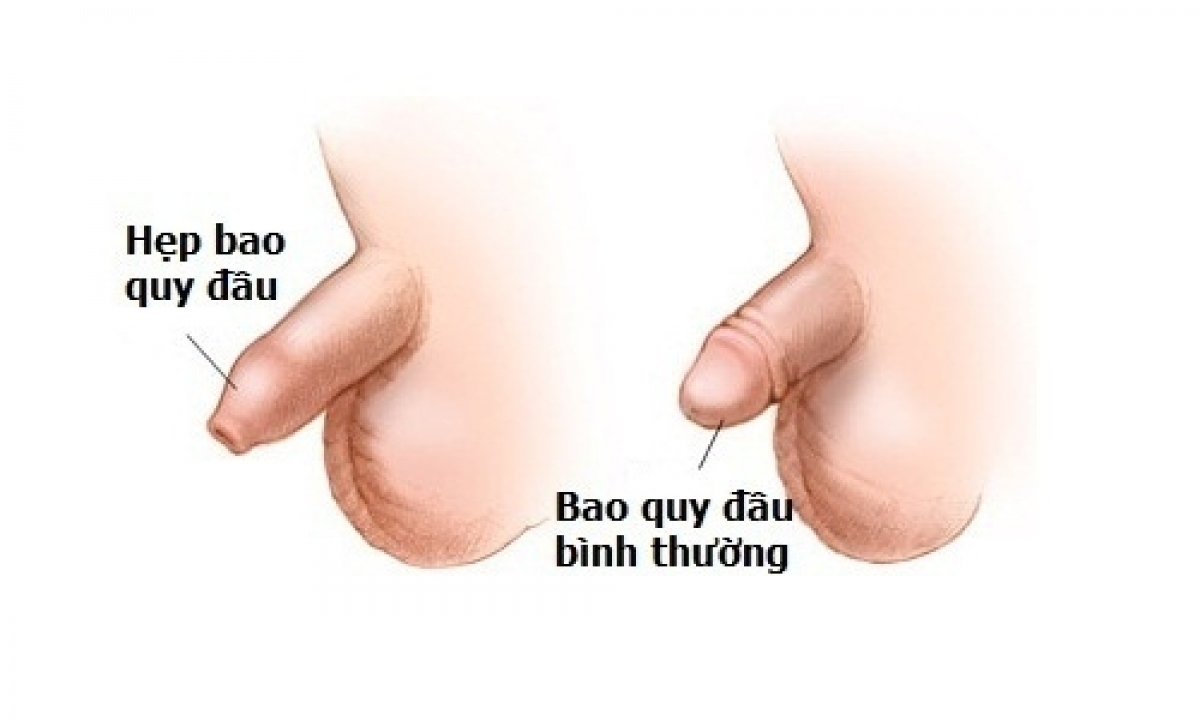 Hình ảnh phân biệt giữa bao quy đầu bình thường và tình trạng hẹp bao quy đầu