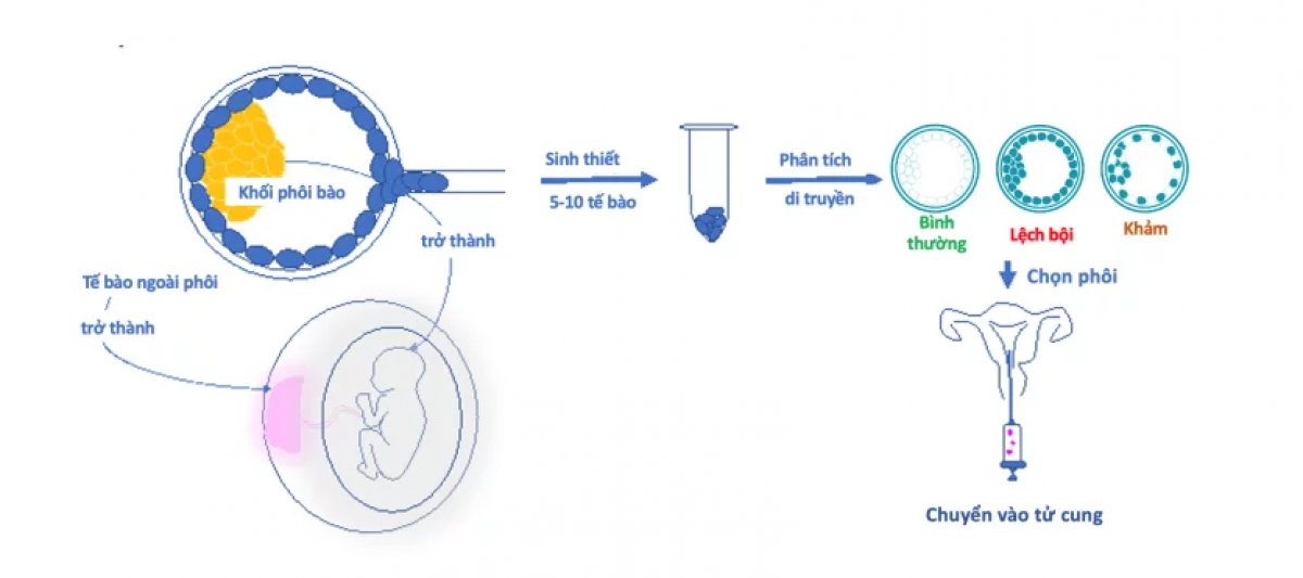 Quy trình sàng lọc phôi để chọn ra phôi khỏe mạnh trước khi chuyển vào buồng tử cung của mẹ