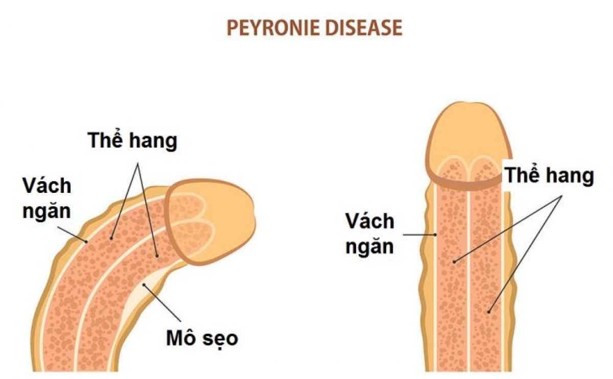 Hình ảnh dương vật bị cong và dương vật bình thường