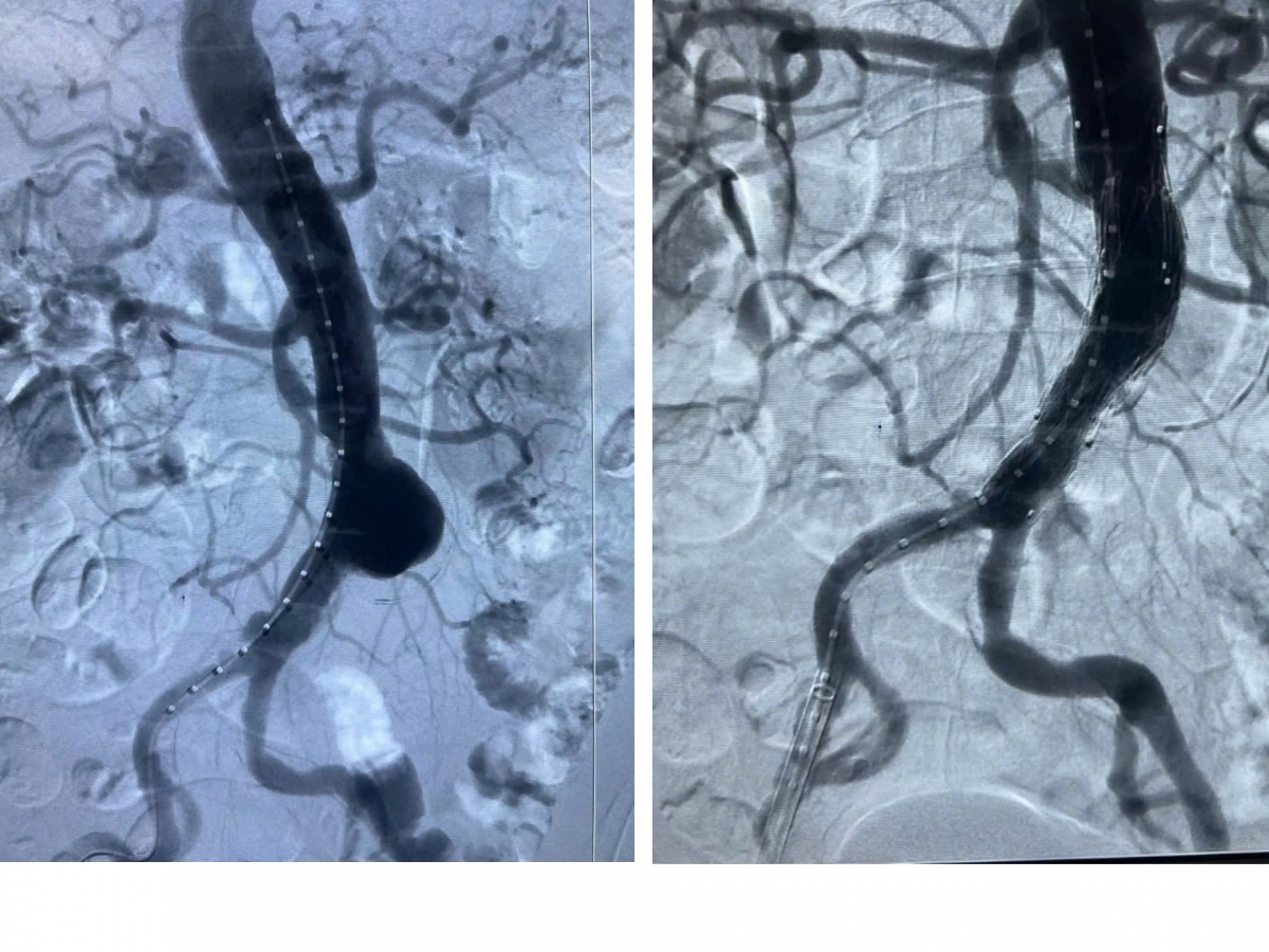 Hình ảnh túi phình động mạch chủ trước và sau can thiệp đặt stent Graft