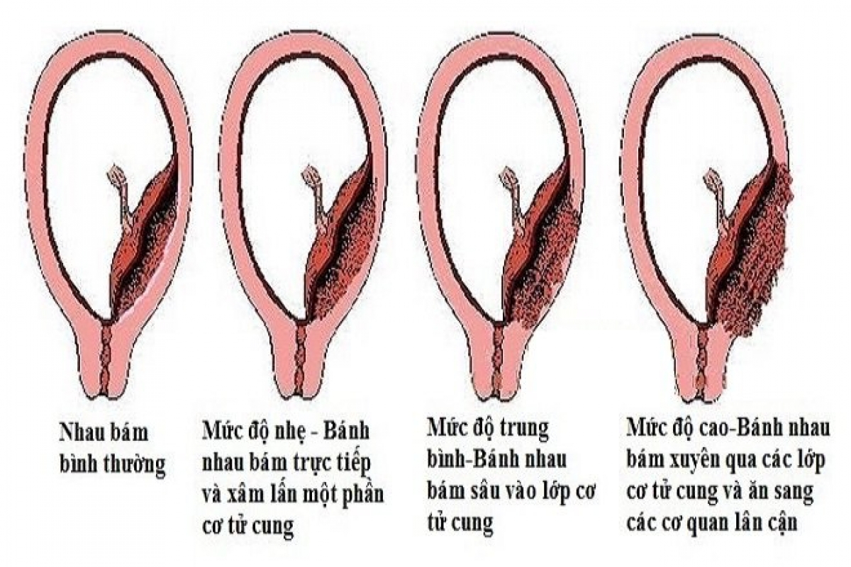 Các mức độ của bệnh lý nhau cài răng lược