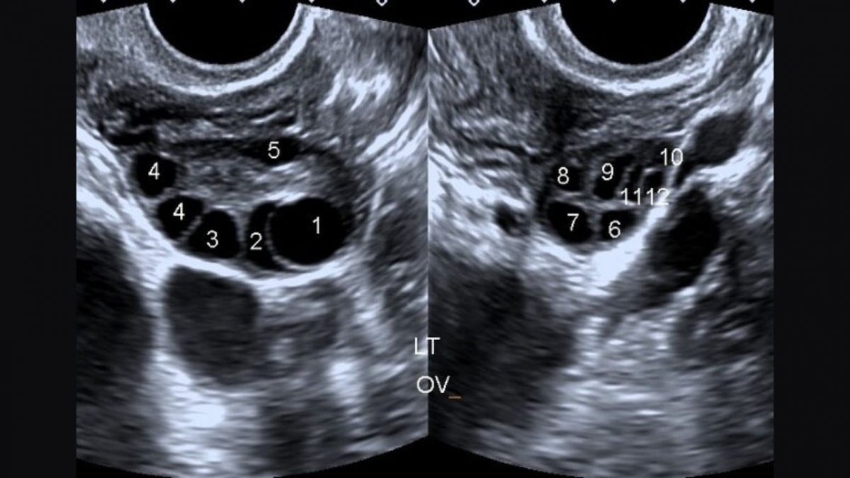 Hình ảnh siêu âm buồng trứng bị đa nang