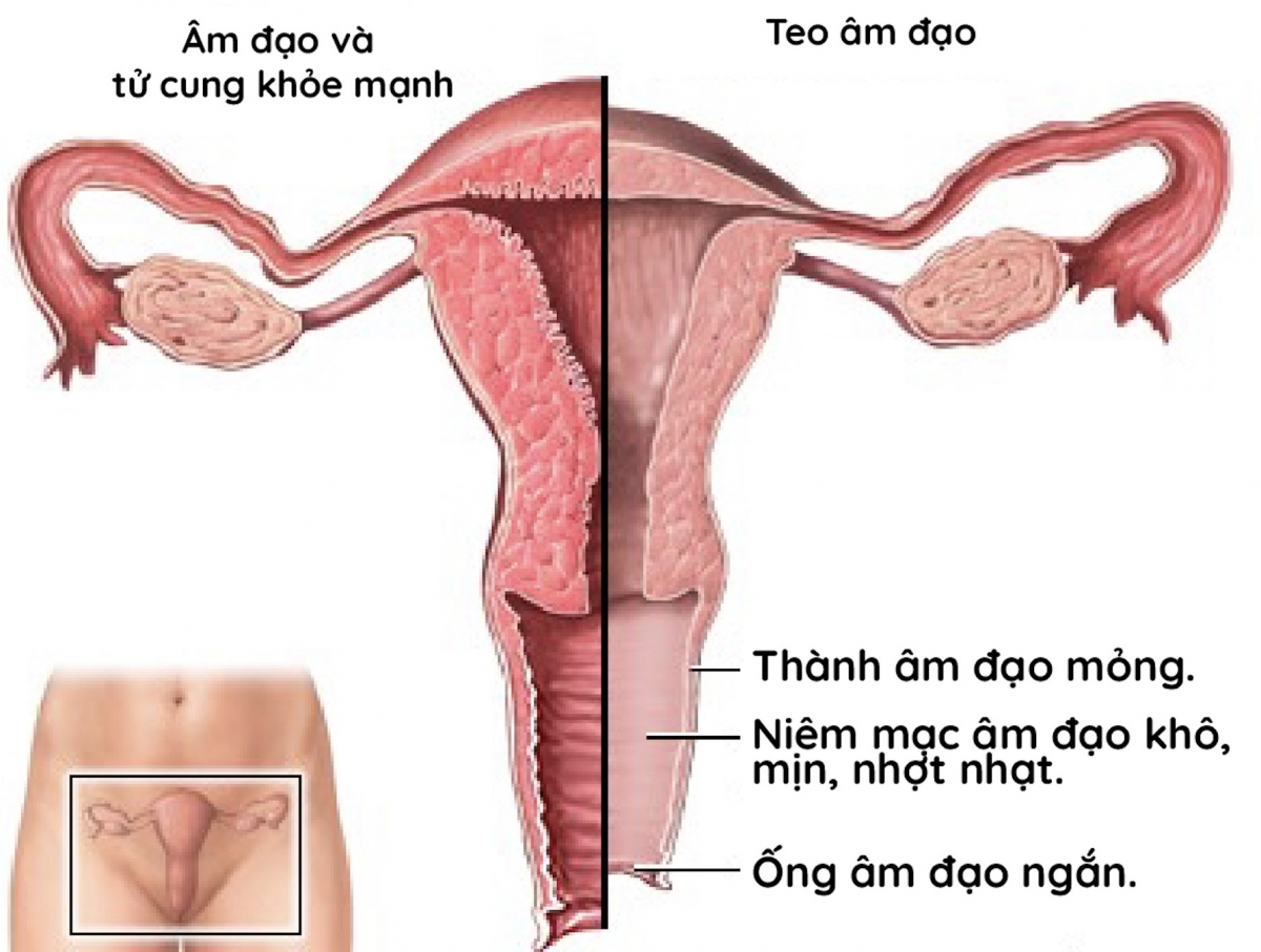 Hình ảnh âm đạo bình thường và âm đạo bị teo khô