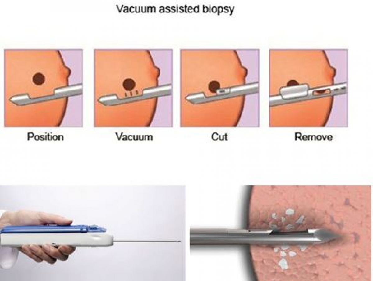 Hình ảnh minh họa quy trình hút u vú chân không
