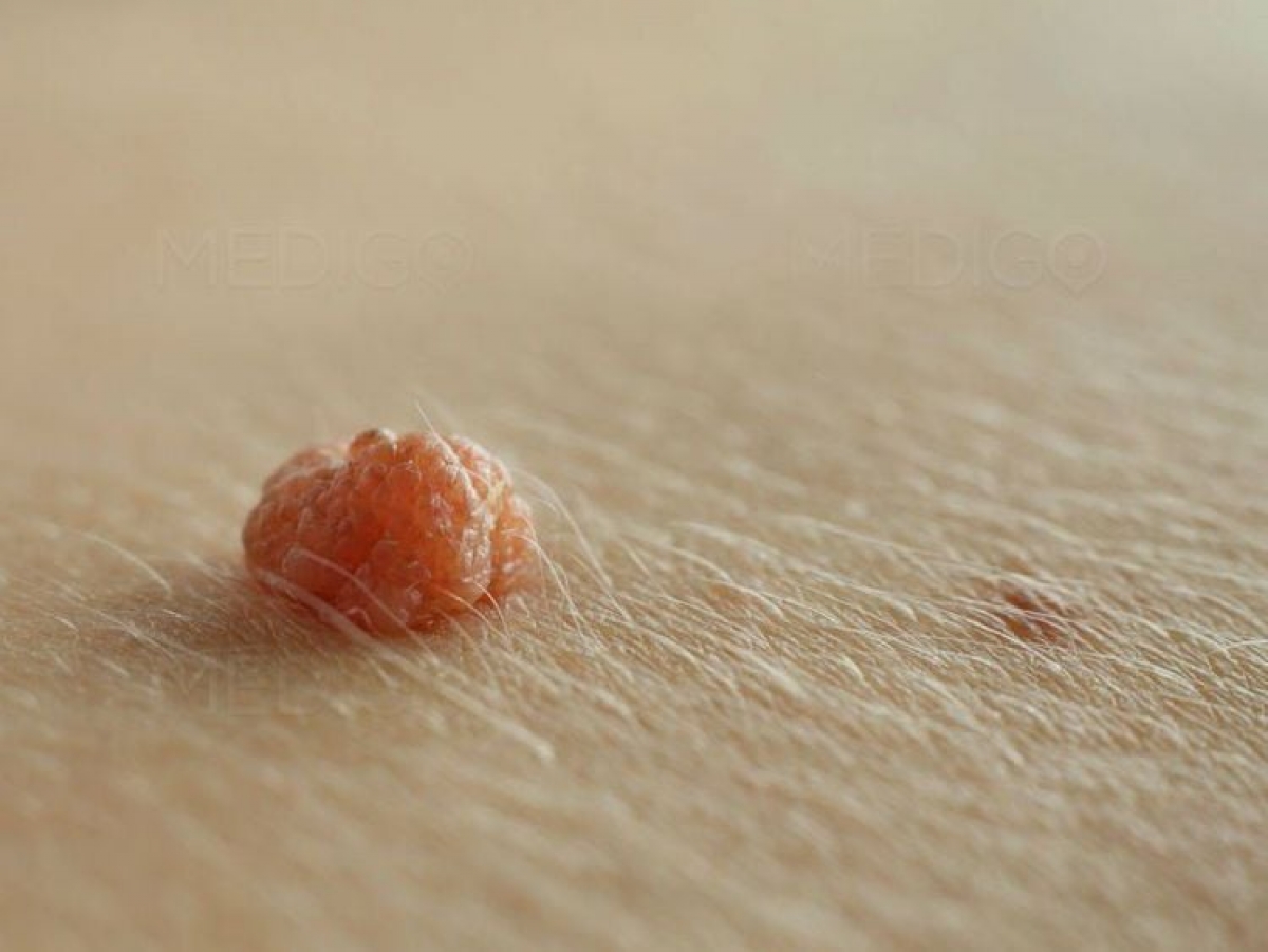 Tổn thương trên da do nhiễm HPV
