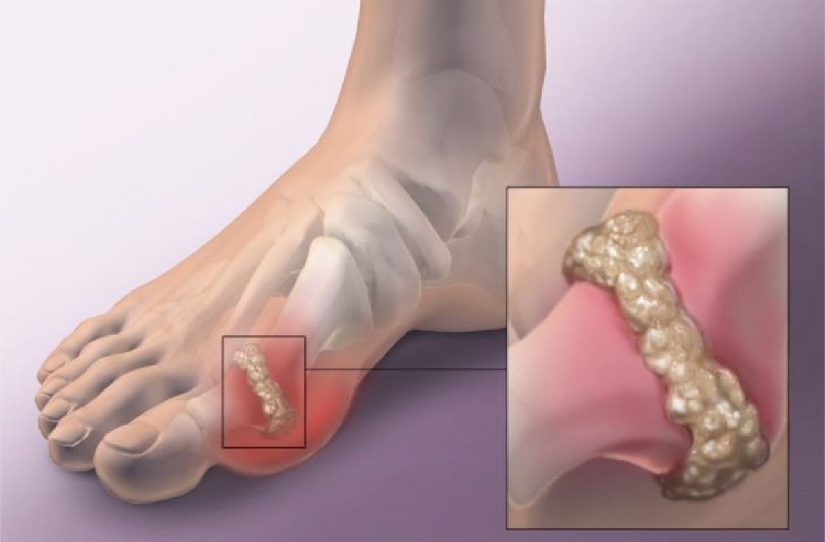 Gout là bệnh mạn tính, có thể dẫn tới nhiều biến chứng nguy hiểm