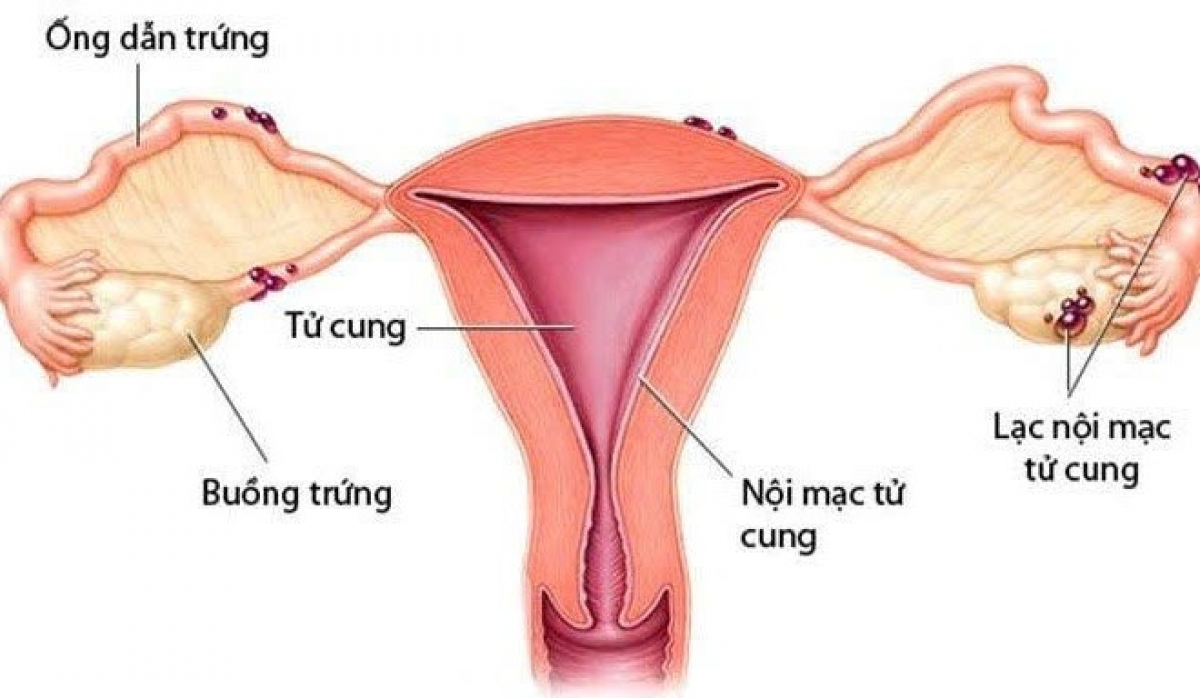 Lạc nội mạc tử cung có thể gây ra vô sinh hiếm muộn (Ảnh: Internet)