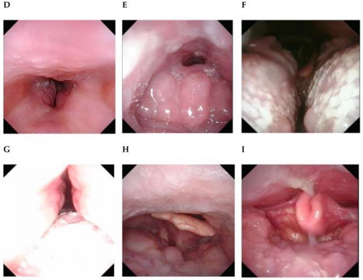A, B, C: xẹp màn hầu trước sau, 2 bên và trung tâm; D: xẹp Amidan; E, F: xẹp đáy lưỡi trước sau và 2 bên; G: xẹp thành bên họng; H, I: xẹp sụn nắp trước sau và 2 bên. Ảnh: BS cung cấp