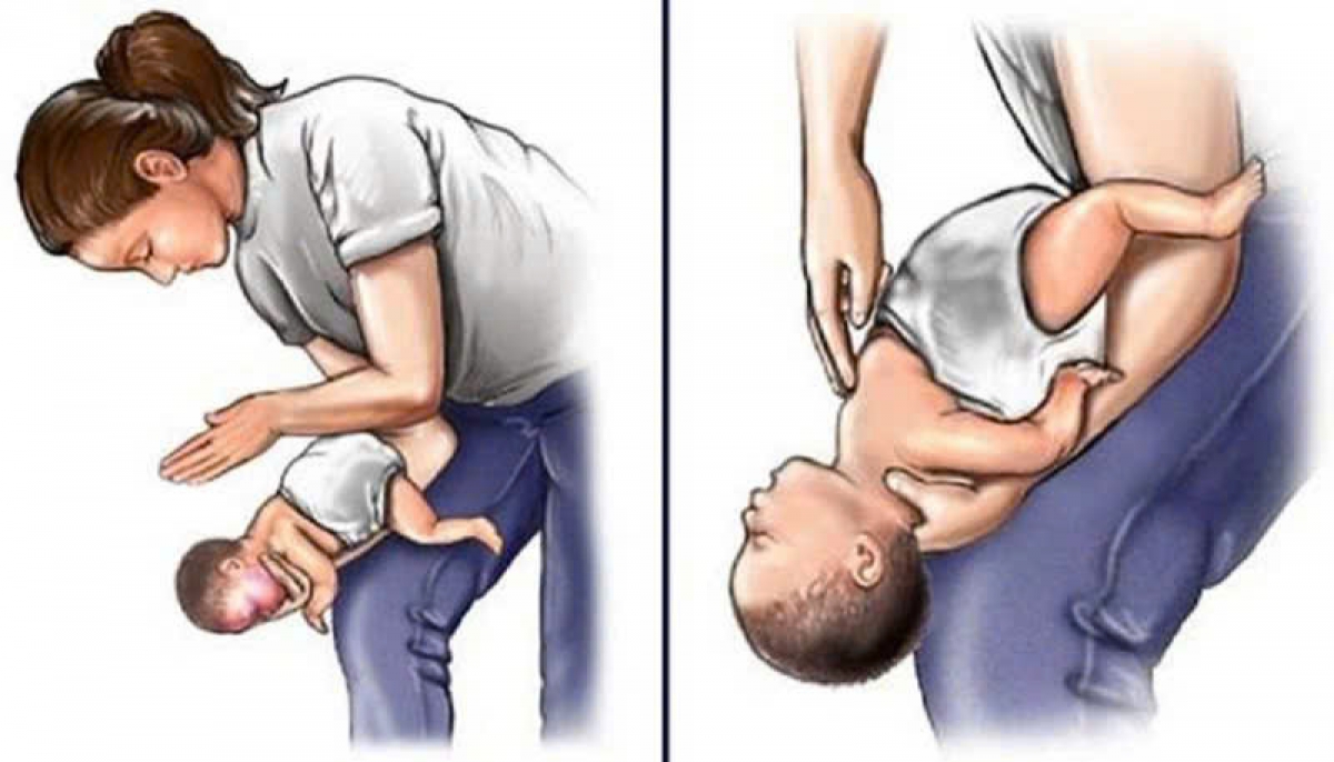 Phương pháp sơ cứu hóc dị vật đường thở ở trẻ nhỏ