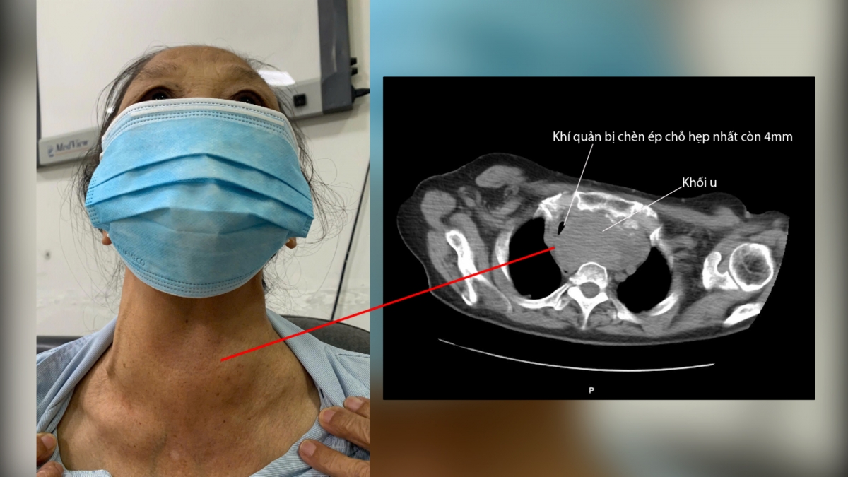 Bà N.T.G. (70 tuổi) bị khối u tuyến giáp chèn ép gây viêm phổi, khó thở. Ảnh: BVCC