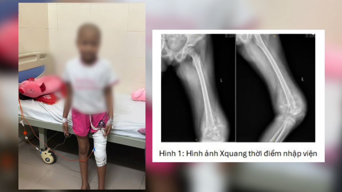 Bé Khoàng Phương Mai sau mổ 1 tuần và thời điểm nhập viện. Ảnh: BVCC