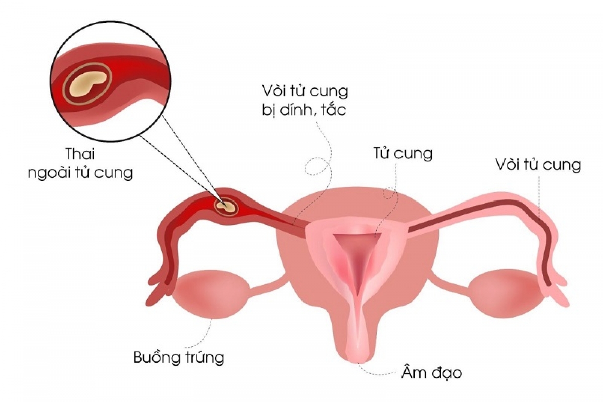 Viêm phần phụ có thể dẫn tới vô sinh và các hậu quả nặng nề khác. Hình minh họa