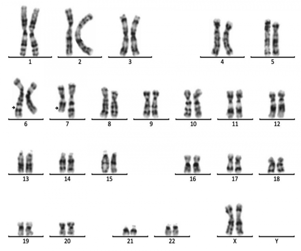 Xét nghiệm nhiễm sắc thể cho thấy bất thường chuyển đoạn tương hỗ giữa nhiễm sắc thể số 6 và số 7. Ảnh: Medlatec 