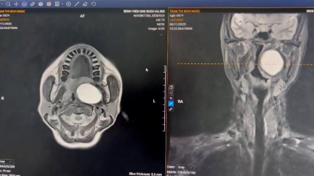 Hình ảnh khối u đẩy lệch trái trên phim chụp CT. Ảnh: BV cung cấp