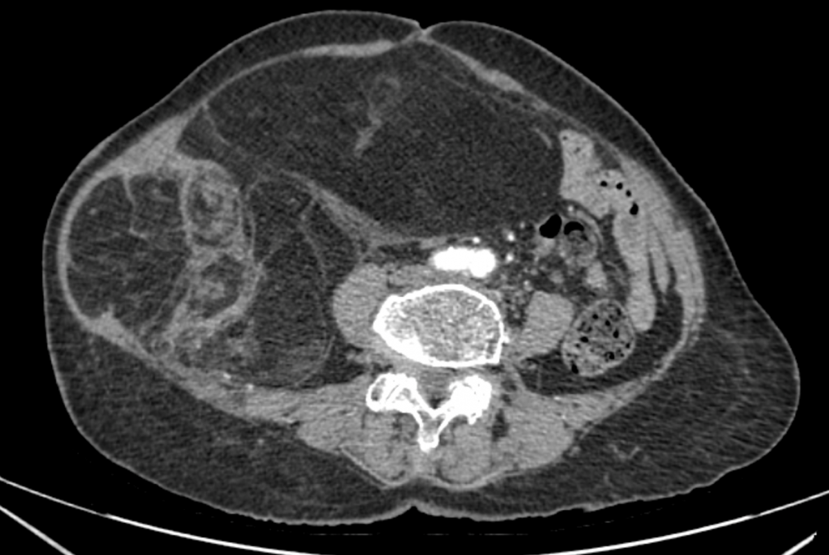 Phim chụp CT ổ bụng bệnh nhân. Ảnh: BVCC