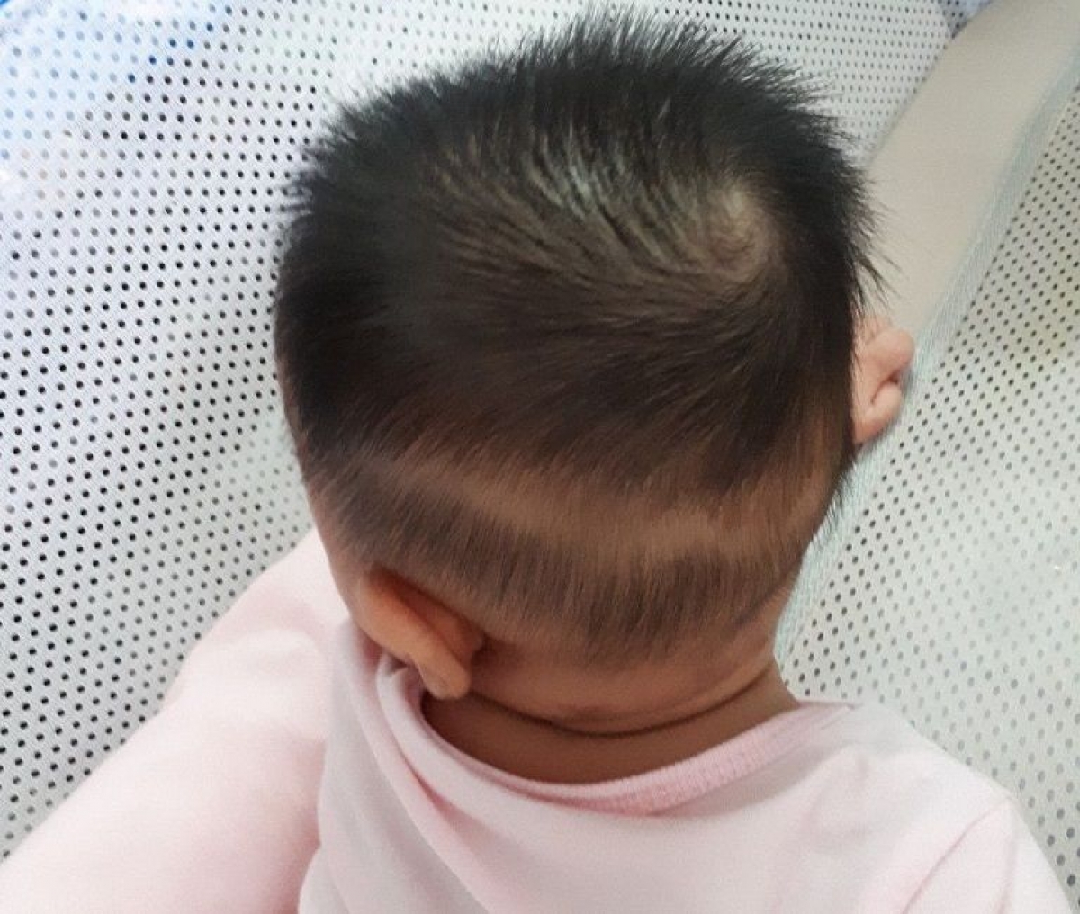 Biểu hiện thường gặp ở trẻ thiếu canxi là rụng tóc hình vành khăn (Ảnh Internet)