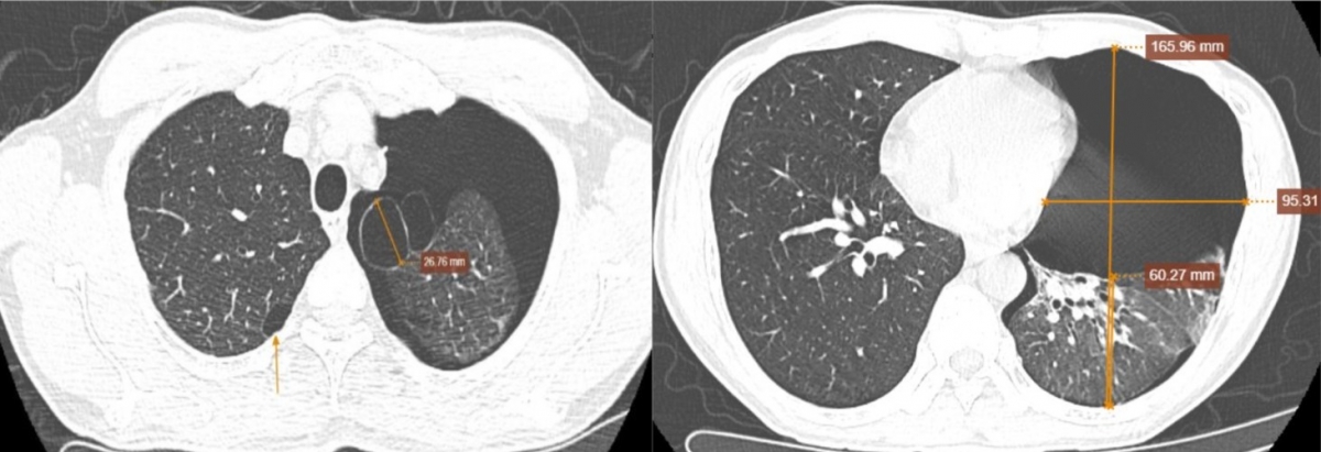 Hình ảnh cho thấy khoang màng phổi của bệnh nhân bị tràn khí mức độ nhiều. Ảnh: BVCC