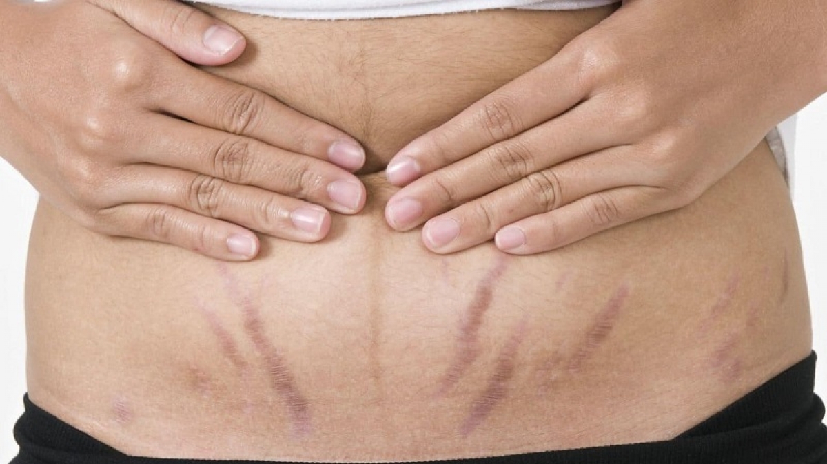 Rạn da sau sinh luôn là vấn đề “đau đầu” của chị em. (Ảnh Internet)