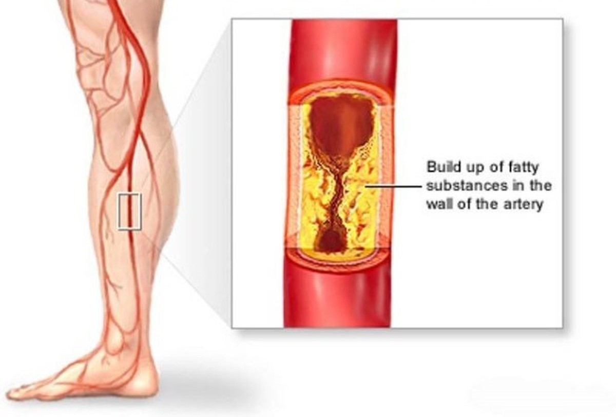 Bệnh động mạch chi dưới rất dễ nặng lên trong mìa lạnh. Ảnh: minh họa