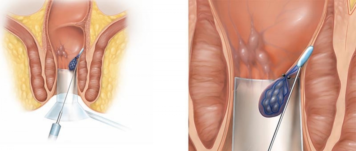 Các phương pháp điều trị ít xâm lấn giúp bệnh nhân trĩ không cần phải phẫu thuật
(Ảnh minh họa)