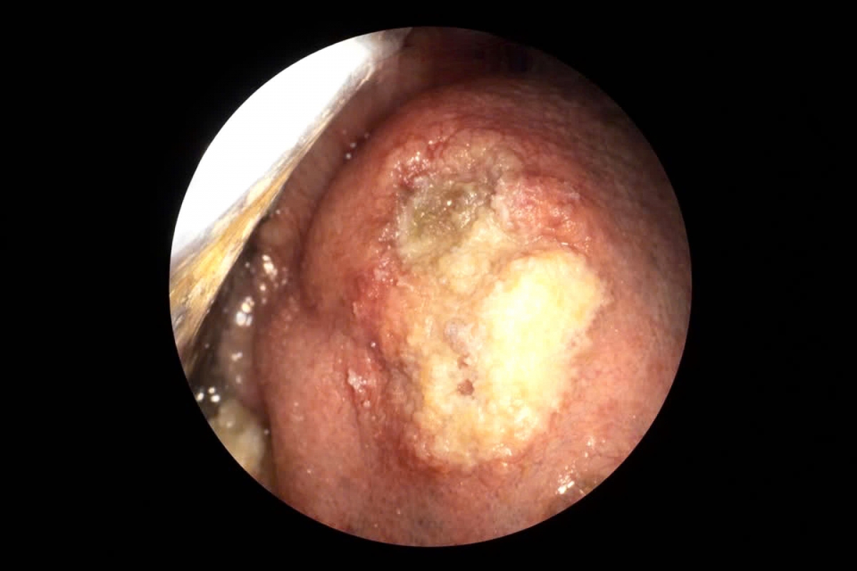 Hình ảnh vét loét ở lưỡi bệnh nhân (ảnh: BVCC)