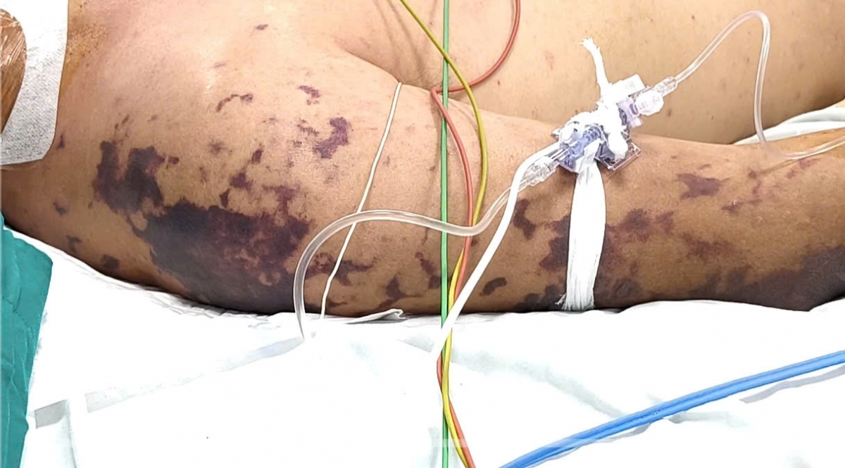 Bệnh nhân xuất hiện nhiều ban xuất huyết dạng tử ban ở mặt, thân mình và hai chi. (ảnh: BVCC)