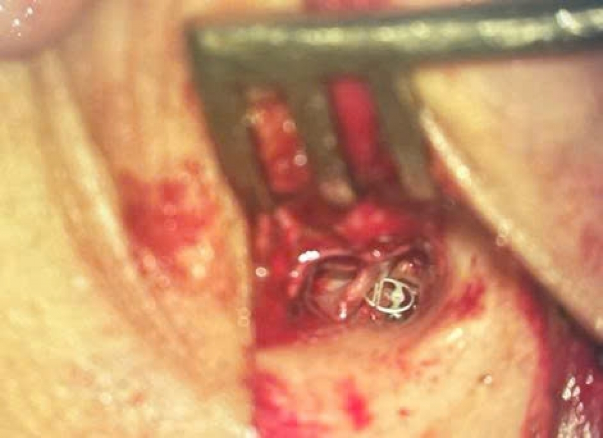 Trụ dẫn nhân tạo (PORP) được đặt từ xương bàn đạp đến màng nhĩ, tái tạo dẫn truyền âm thanh. Ảnh: BVCC