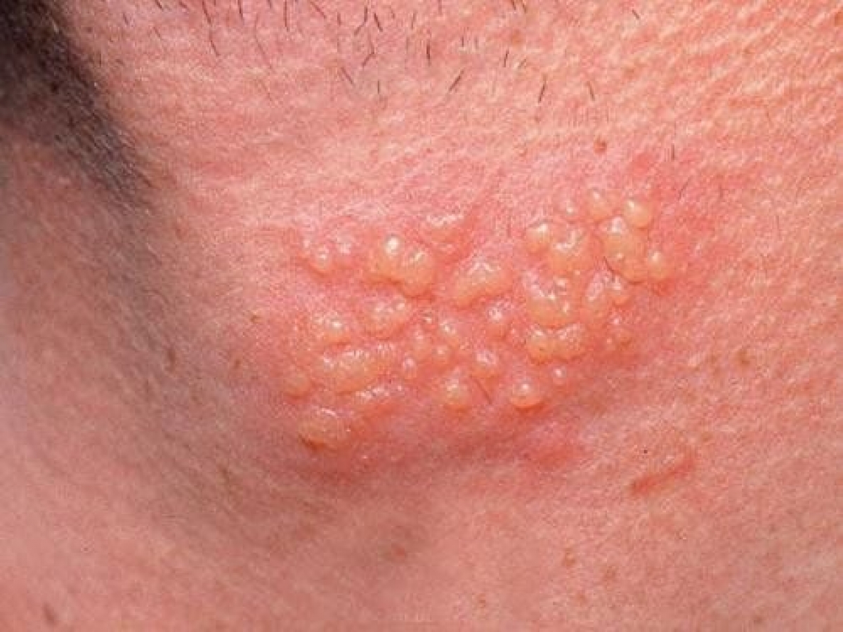 Triệu chứng của bệnh sùi mào gà. Ảnh: internet