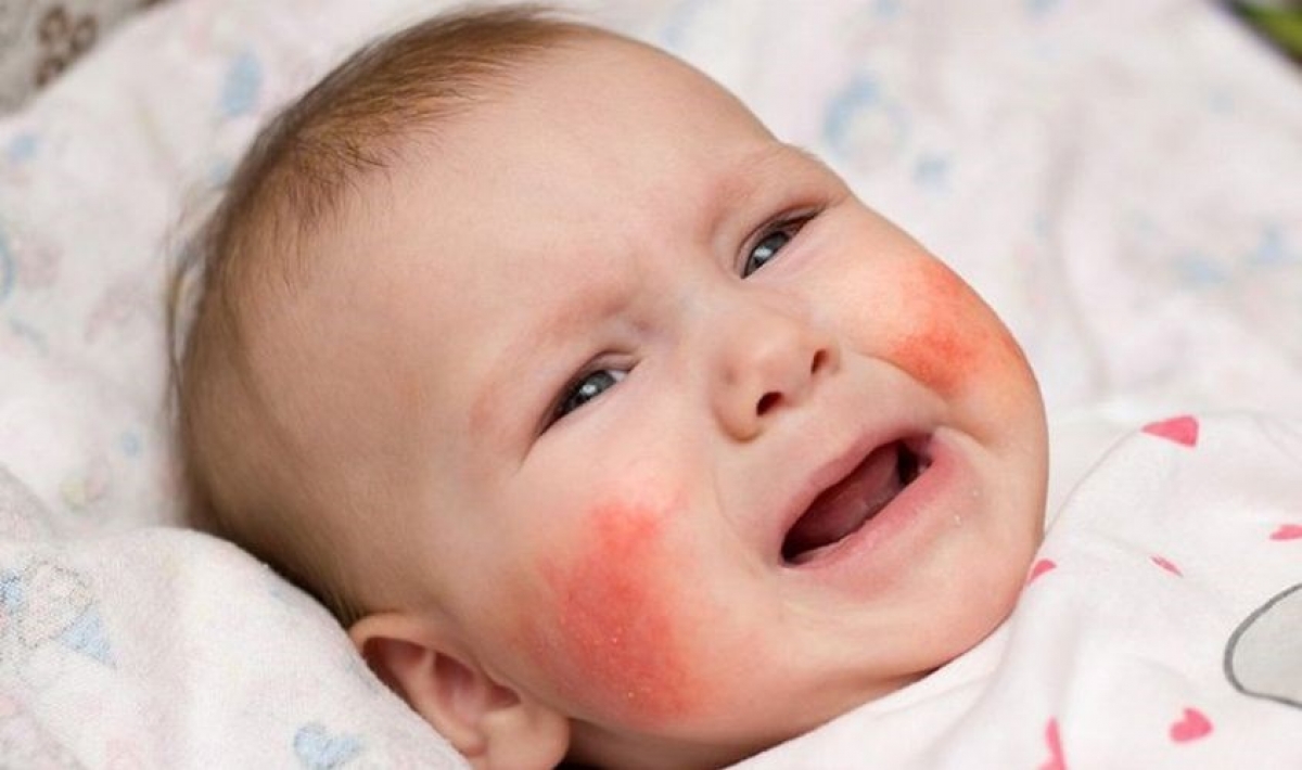 Việc chăm sóc da không đúng cách có thể khiến tinh trạng viêm da của trẻ nặng lên. (Ảnh Internet)