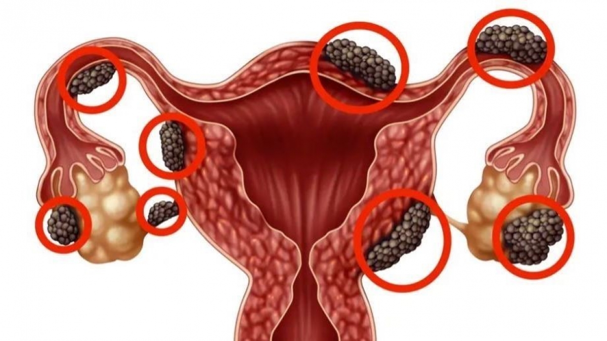 Hình ảnh khối lạc nội mạc bên ngoài tử cung. Ảnh: Internet