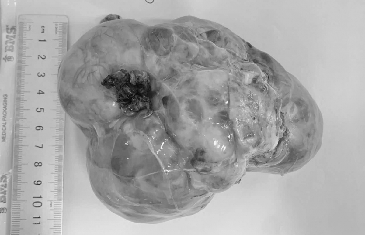 Một khối u được lấy ra từ bệnh nhi (Ảnh: Internet)