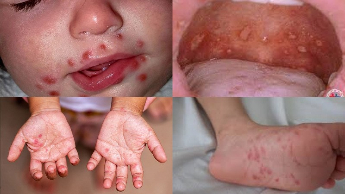 Vết loét ở miệng, phát ban trên cơ thể là các triệu chứng điển hình của tay chân miệng. (Ảnh Internet)