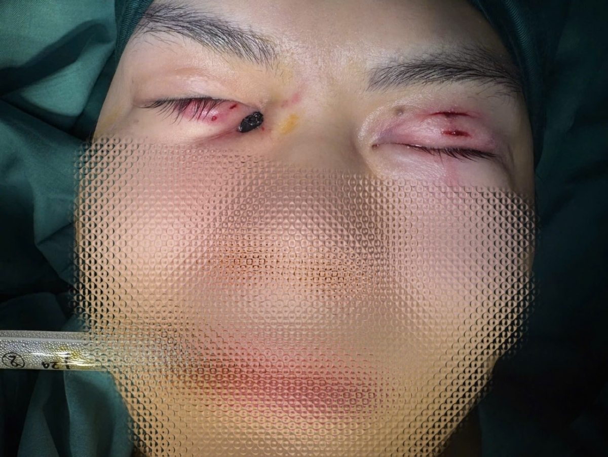 Người bệnh vào viện với 1 bên dị vật lộ phần đầu rất ngắn, 1 bên nằm sâu hoàn toàn bên trong hốc mắt (Ảnh: BVCC)