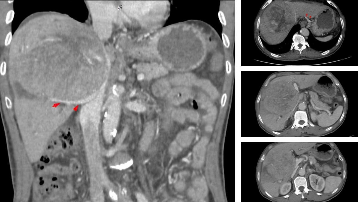 Khối u ở lần mổ đầu tiên vào tháng 7/2023 (Ảnh: BVCC)
