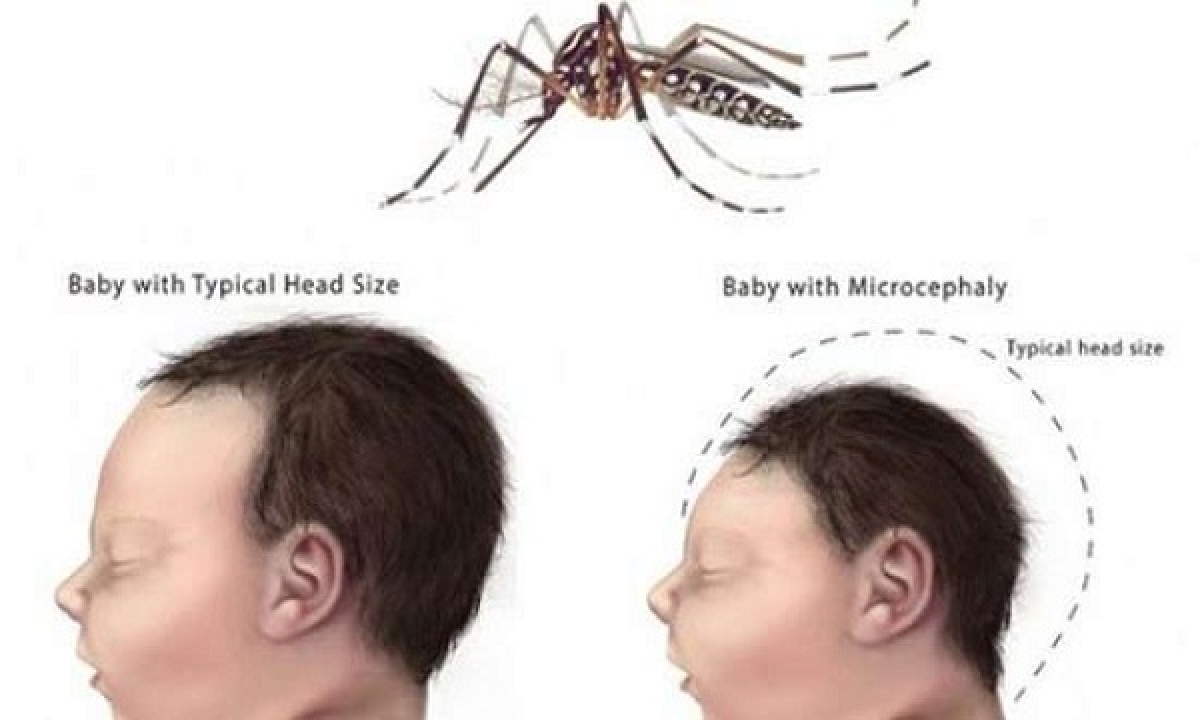 Virus Zika gây dị tật ở trẻ nhỏ (Ảnh: Internet)
